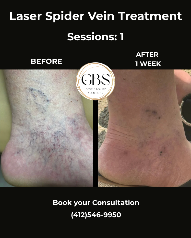 Laser spider vein treatment before-and-after legs, showing improvement after 1 week; book consultation info.