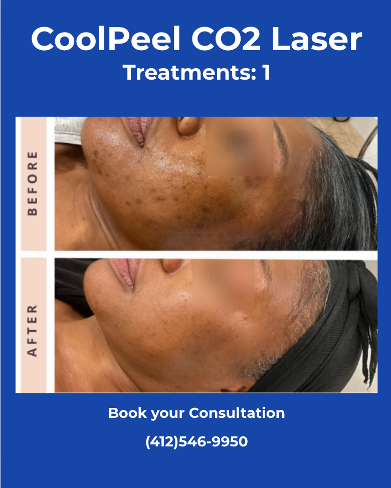 CoolPeel CO2 laser treatment before-and-after facial 