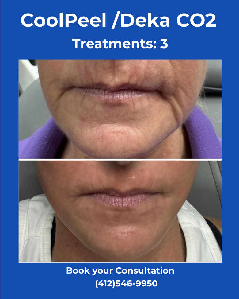 Before-and-after close-up of lips and lower face for CoolPeel/Deka CO2 treatment
