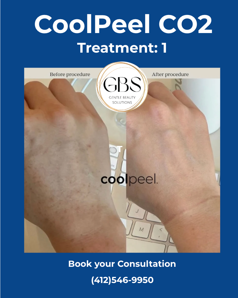 CO2 Fractional Laser Resurfacing