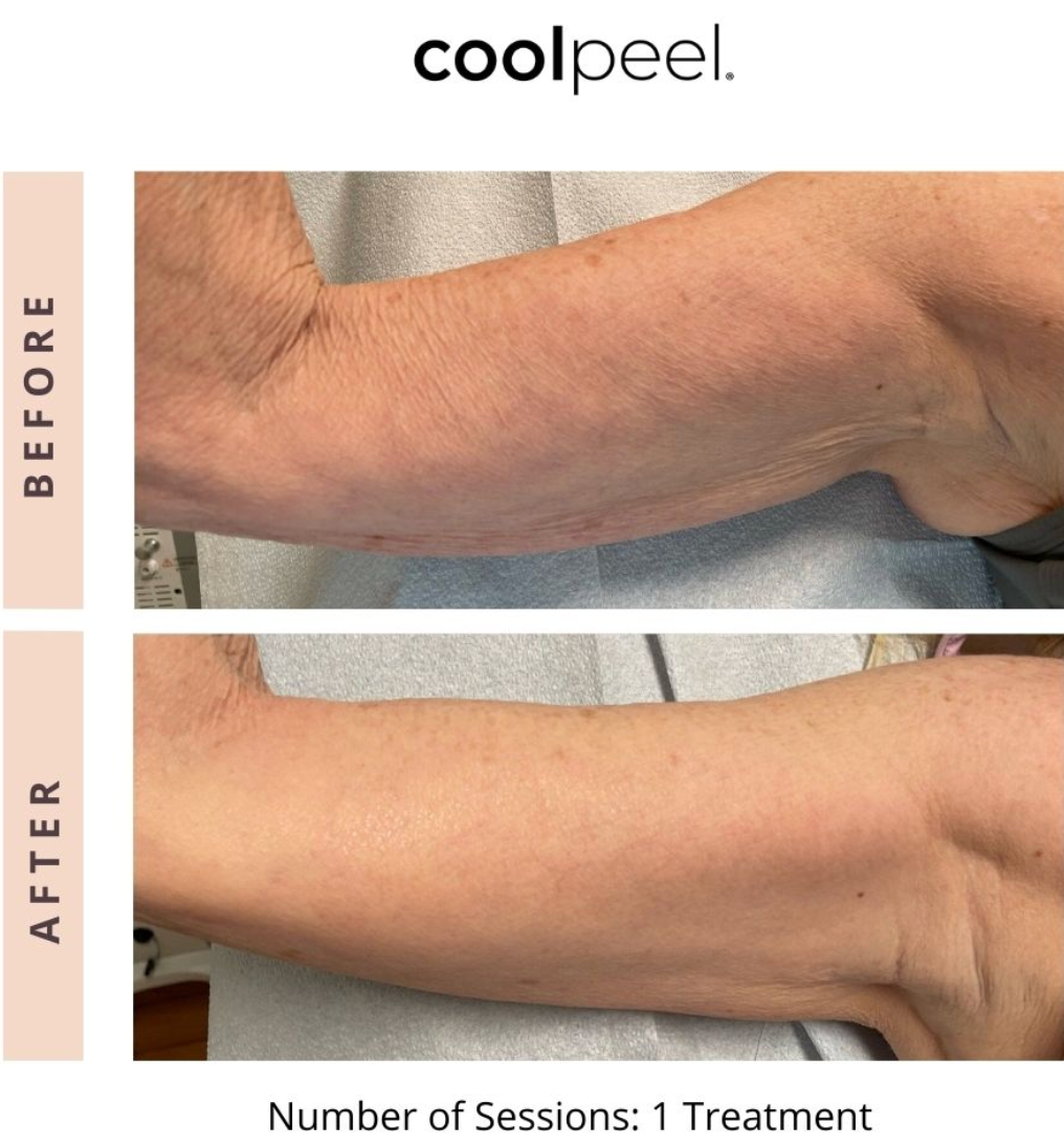 Before-and-after arm skin treatment results, showing smoother skin after one session.