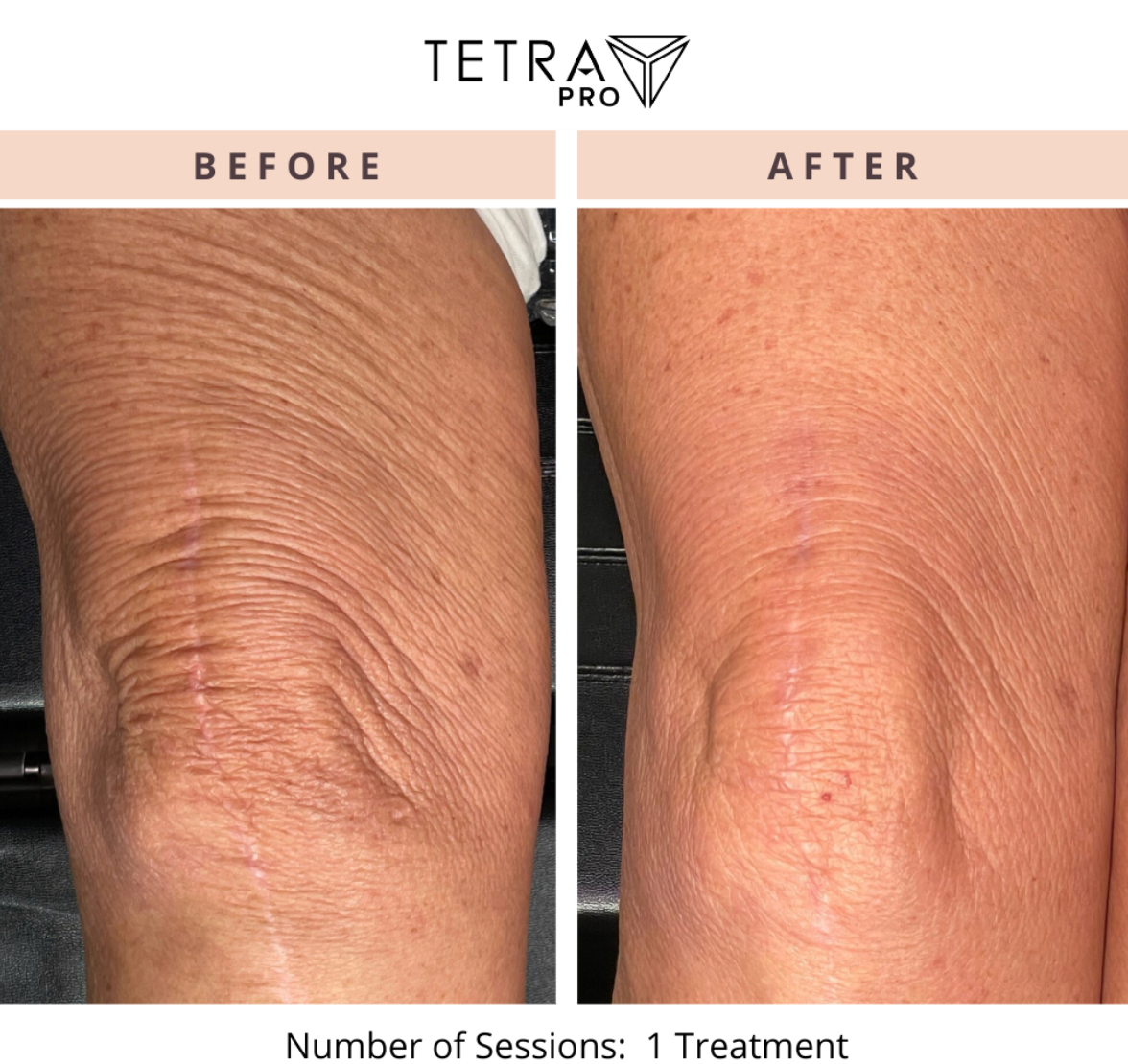 CO2 Fractional Laser Resurfacing