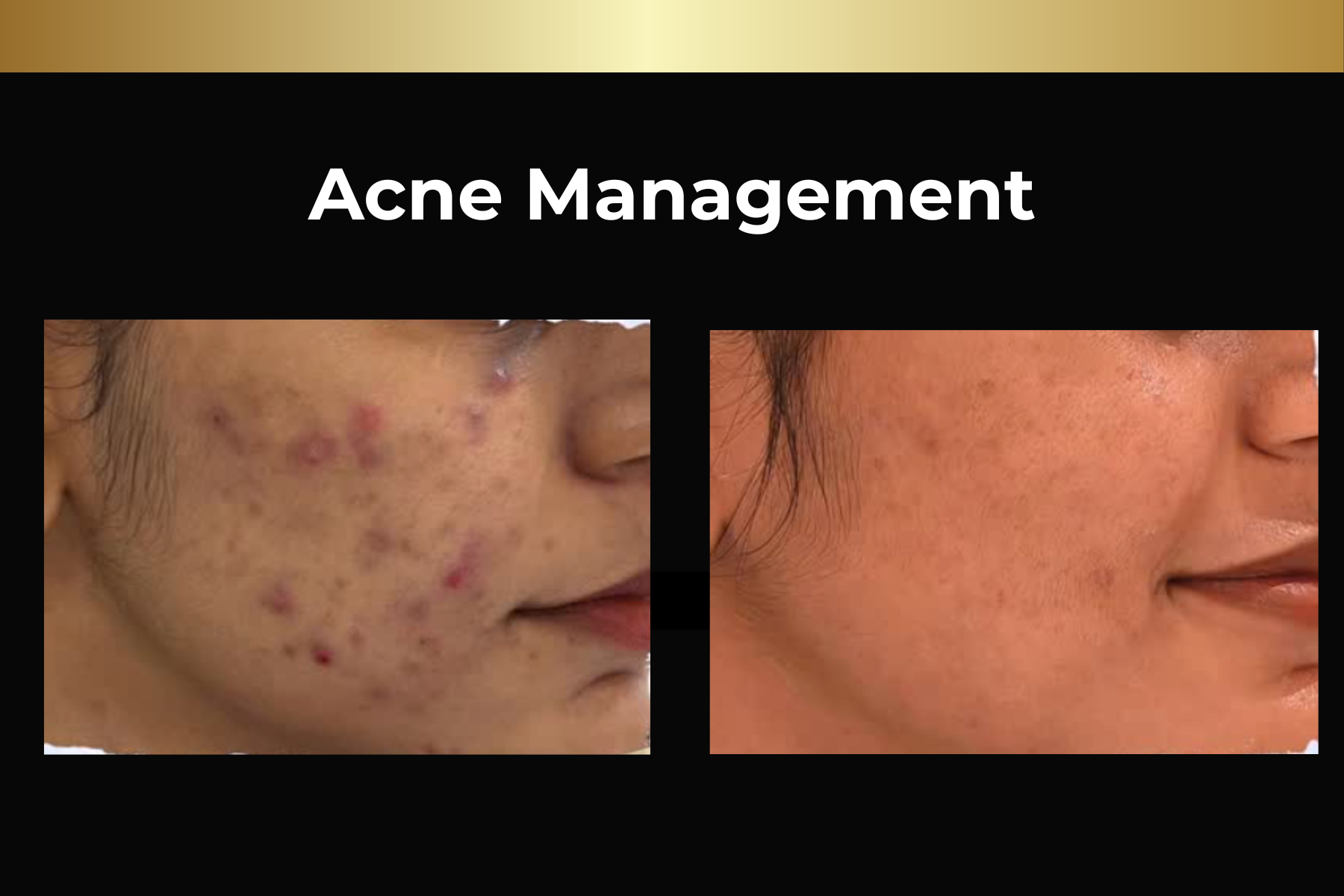 Microneedling skin pen treatment before-and-after facial closeups for Toskani Proage + NCPR, 1 treatment