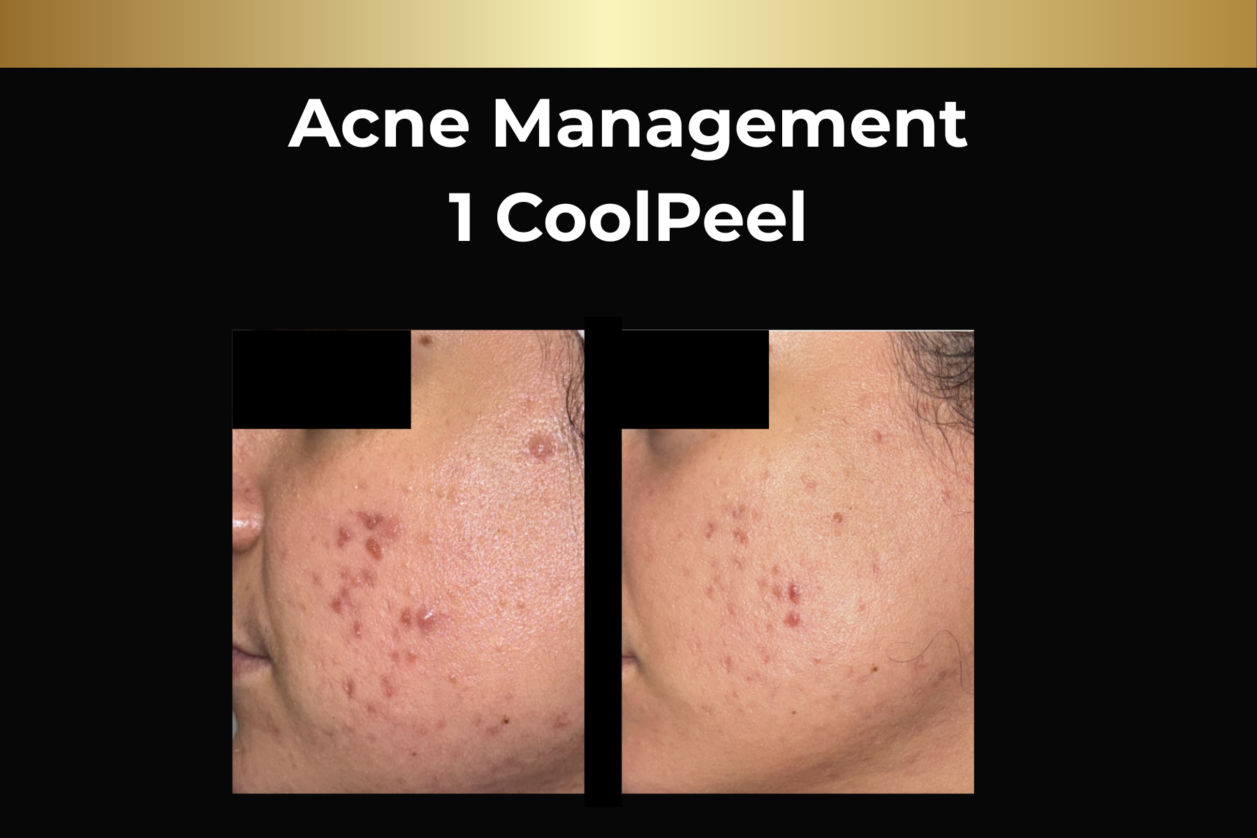 Microneedling skin pen treatment before-and-after facial closeups for Toskani Proage + NCPR, 1 treatment