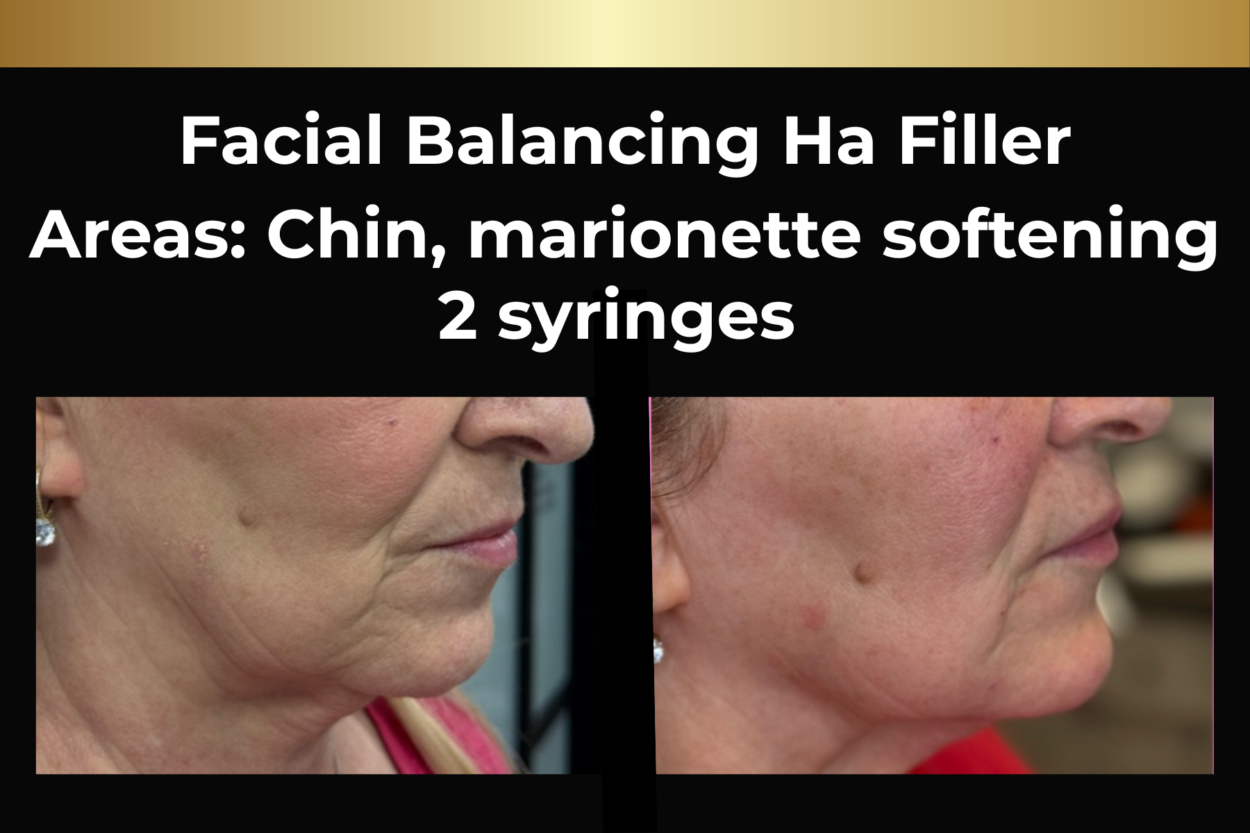Microneedling skin pen treatment before-and-after facial closeups for Toskani Proage + NCPR, 1 treatment