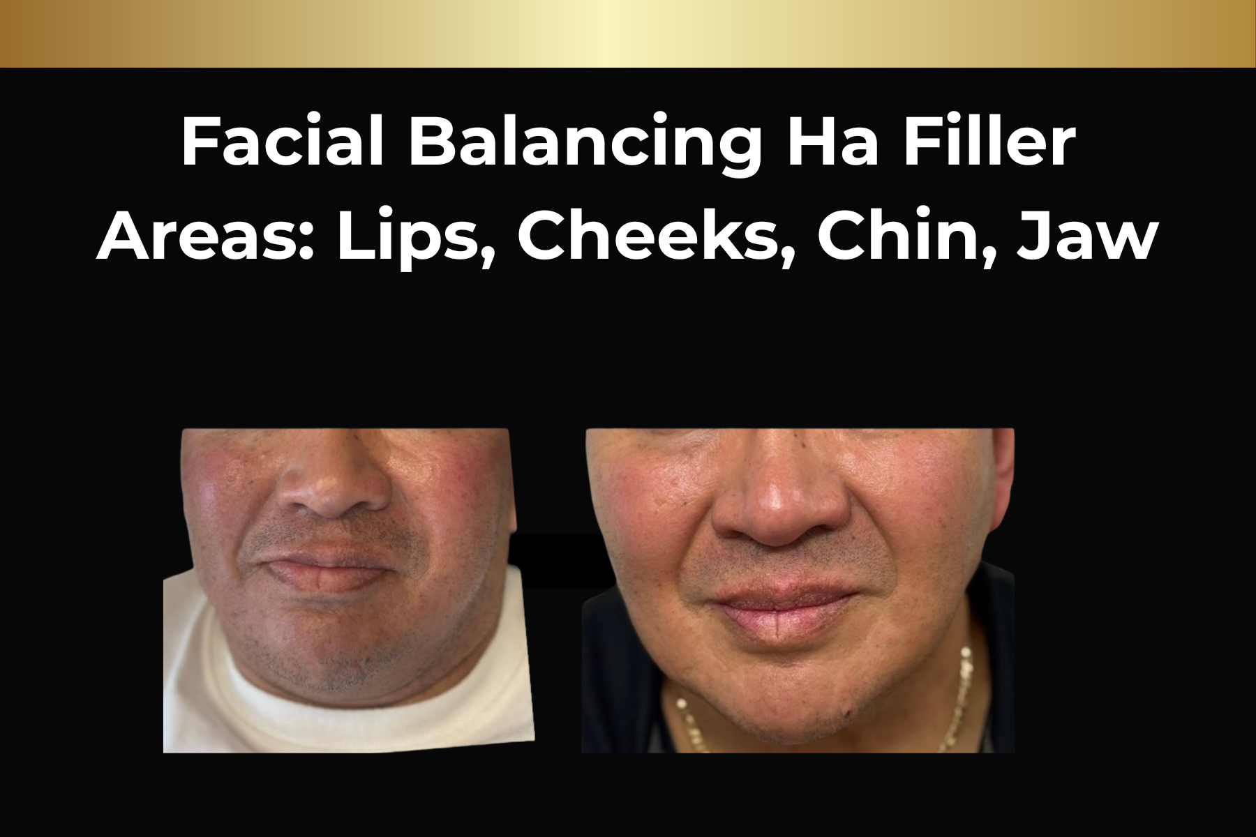 Before-and-after facial close-up showing acne scars treated with microneedling skin pen, labeled “1 treatment.”