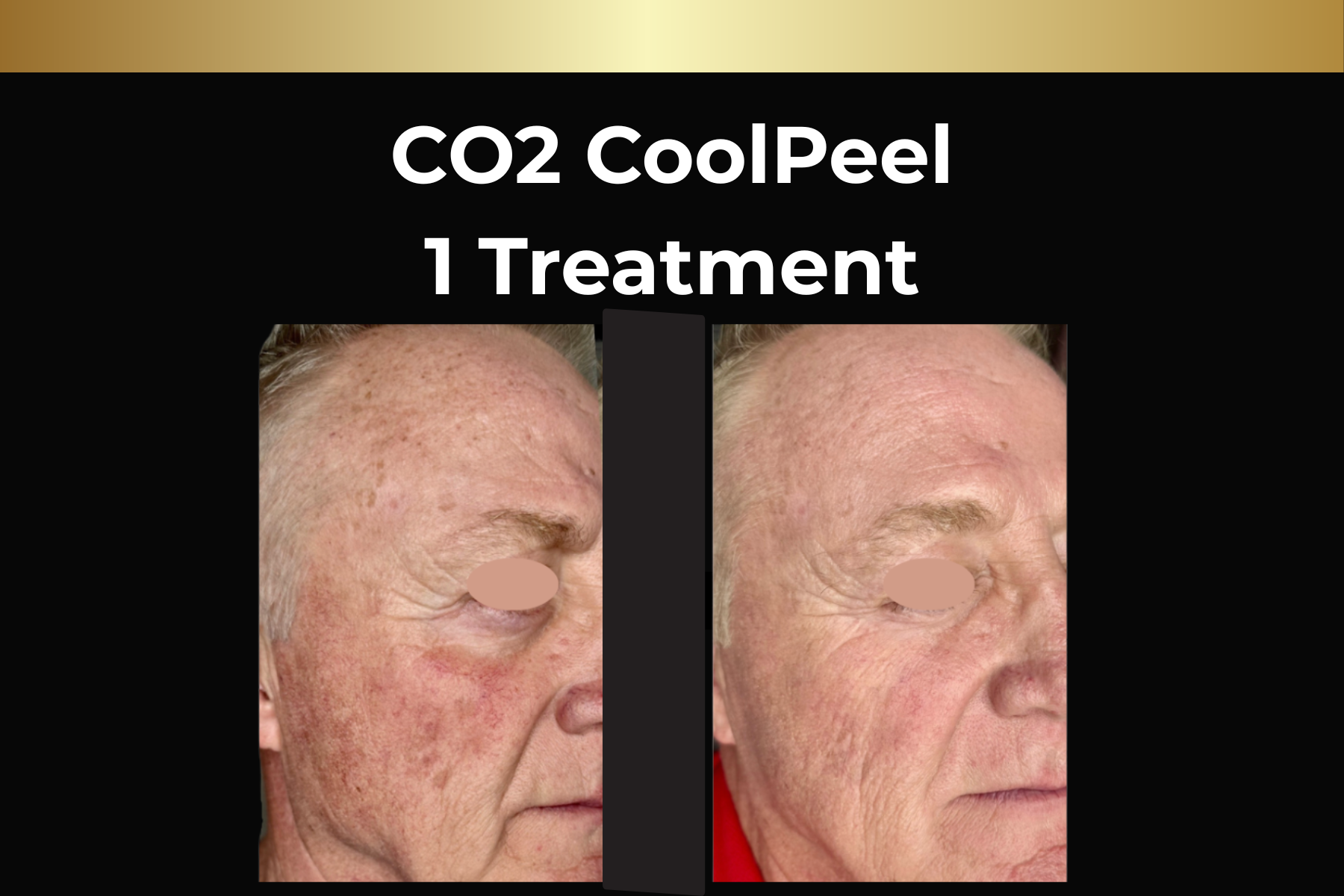 Before-and-after arm photos showing hair reduction after 5 laser hair removal treatments