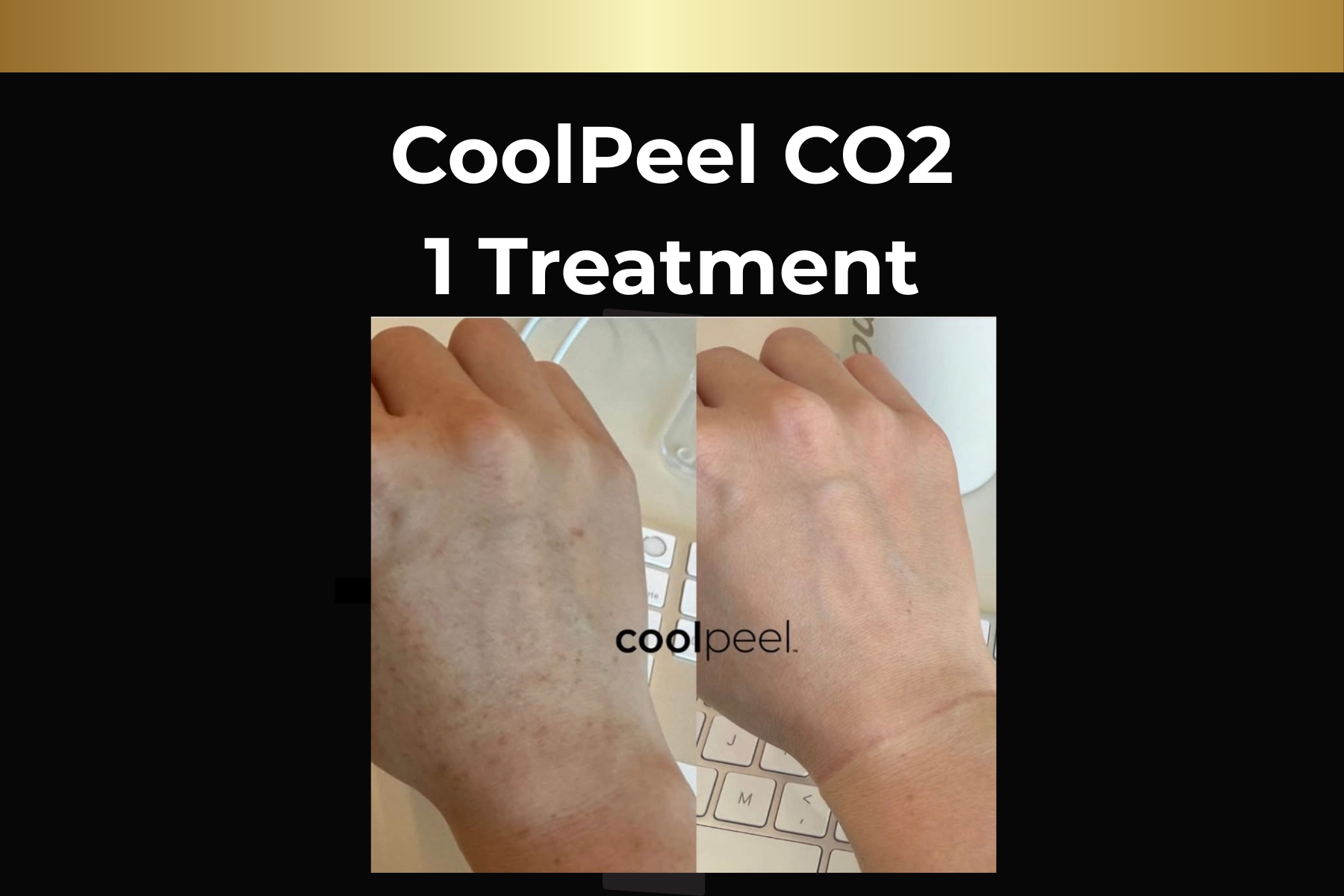 Before-and-after underarm laser hair removal, showing reduced hair after 5 sessions.