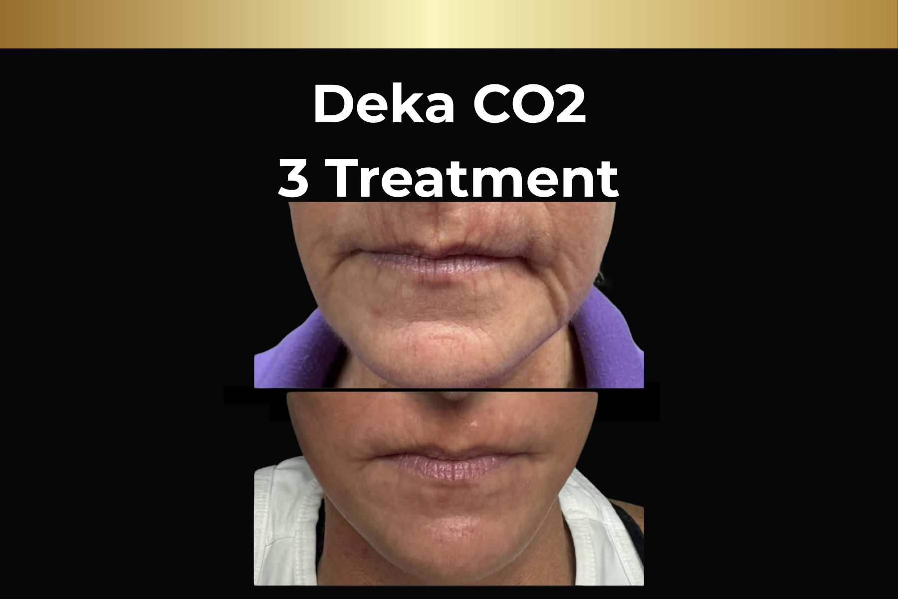Before-and-after close-up of a leg showing reduced hair after 6 laser hair removal treatments.