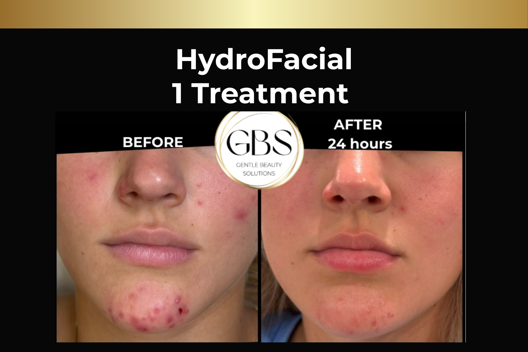 Microneedling skin pen treatment before-and-after facial closeups for Toskani Proage + NCPR, 1 treatment