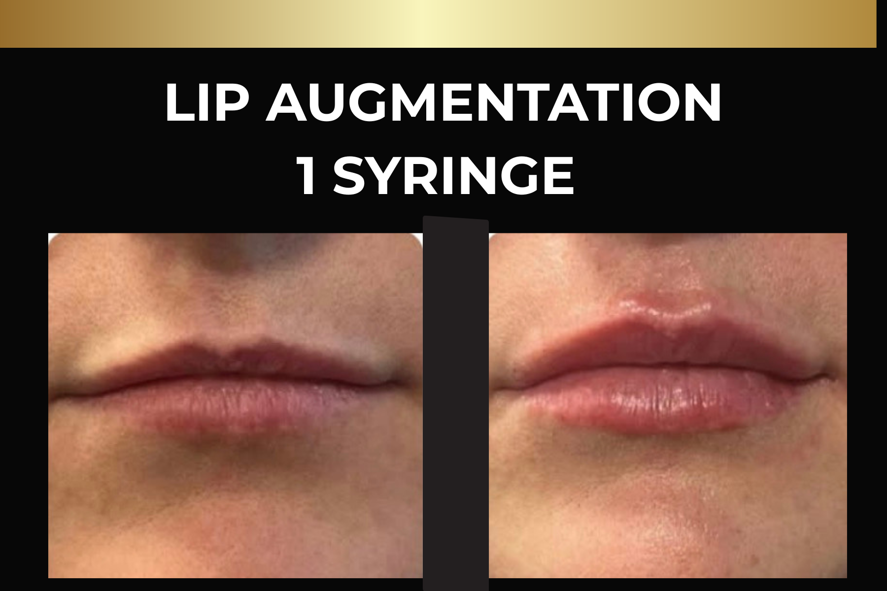 Microneedling skin pen treatment before-and-after facial closeups for Toskani Proage + NCPR, 1 treatment