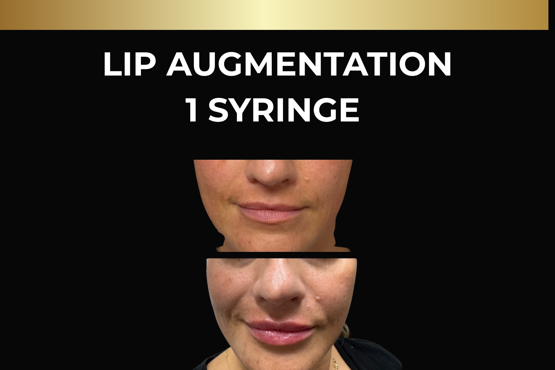 Before-and-after facial close-up showing acne scars treated with microneedling skin pen, labeled “1 treatment.”