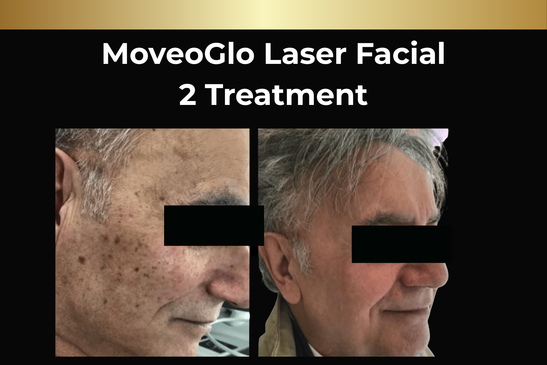 Before-and-after facial side-profile photos showing skin improvement after one laser MoveoGlo treatment.
