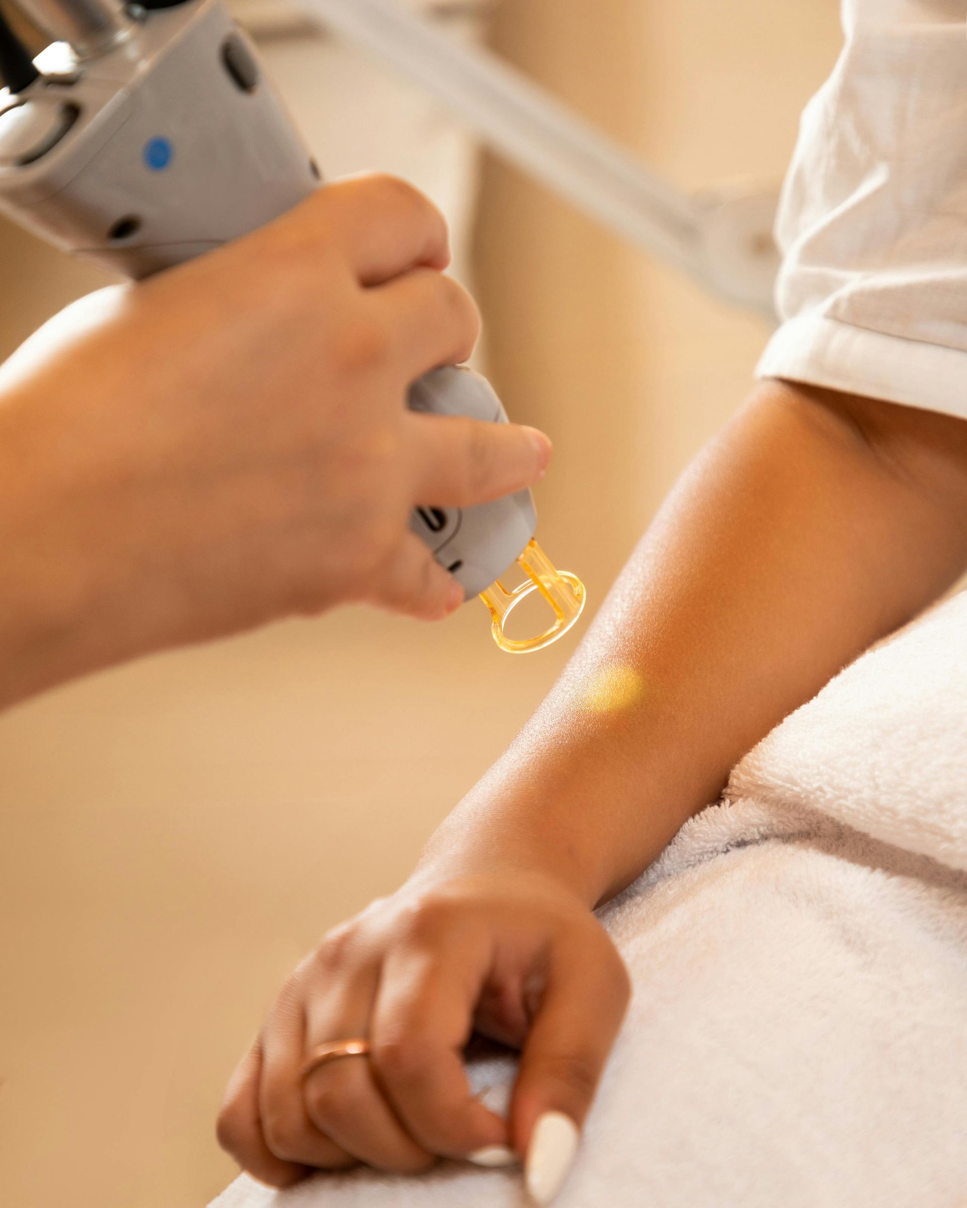 Laser treatment on a person's arm, held by a gloved hand.