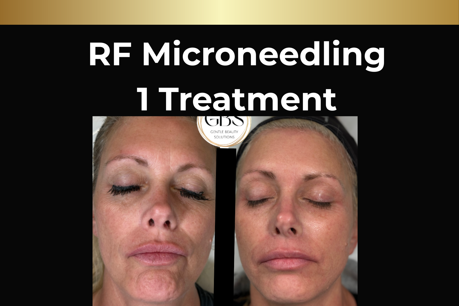 Microneedling skin pen treatment before-and-after facial closeups for Toskani Proage + NCPR, 1 treatment