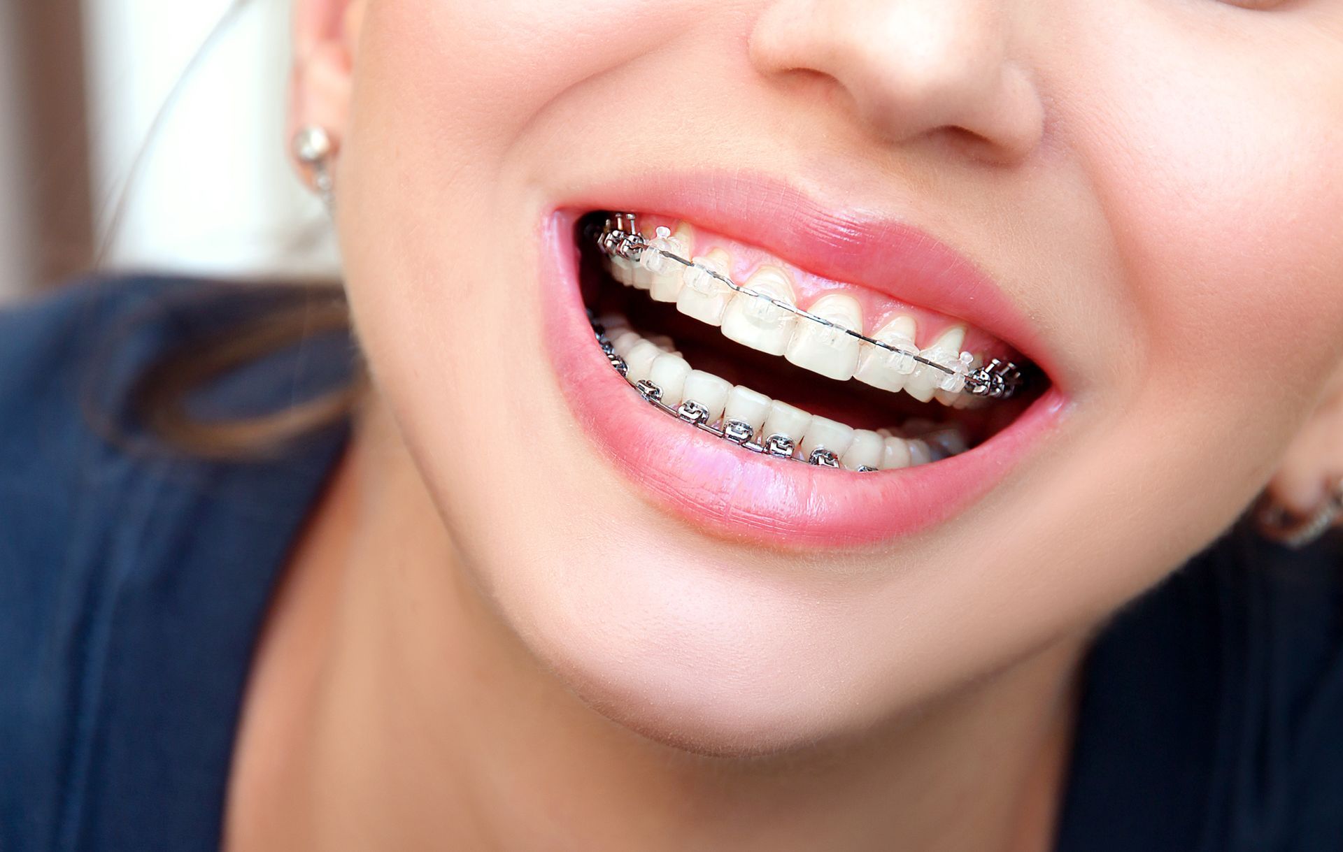 Closeup of a female smile with ceramic braces on teeth Closeup of a female smile with ceramic braces on teeth