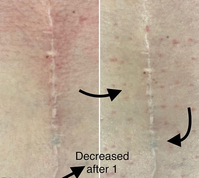 Lumbar Fusion Scar