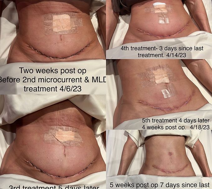 Tummy Tuck Mld & Scar Tissue Treatment