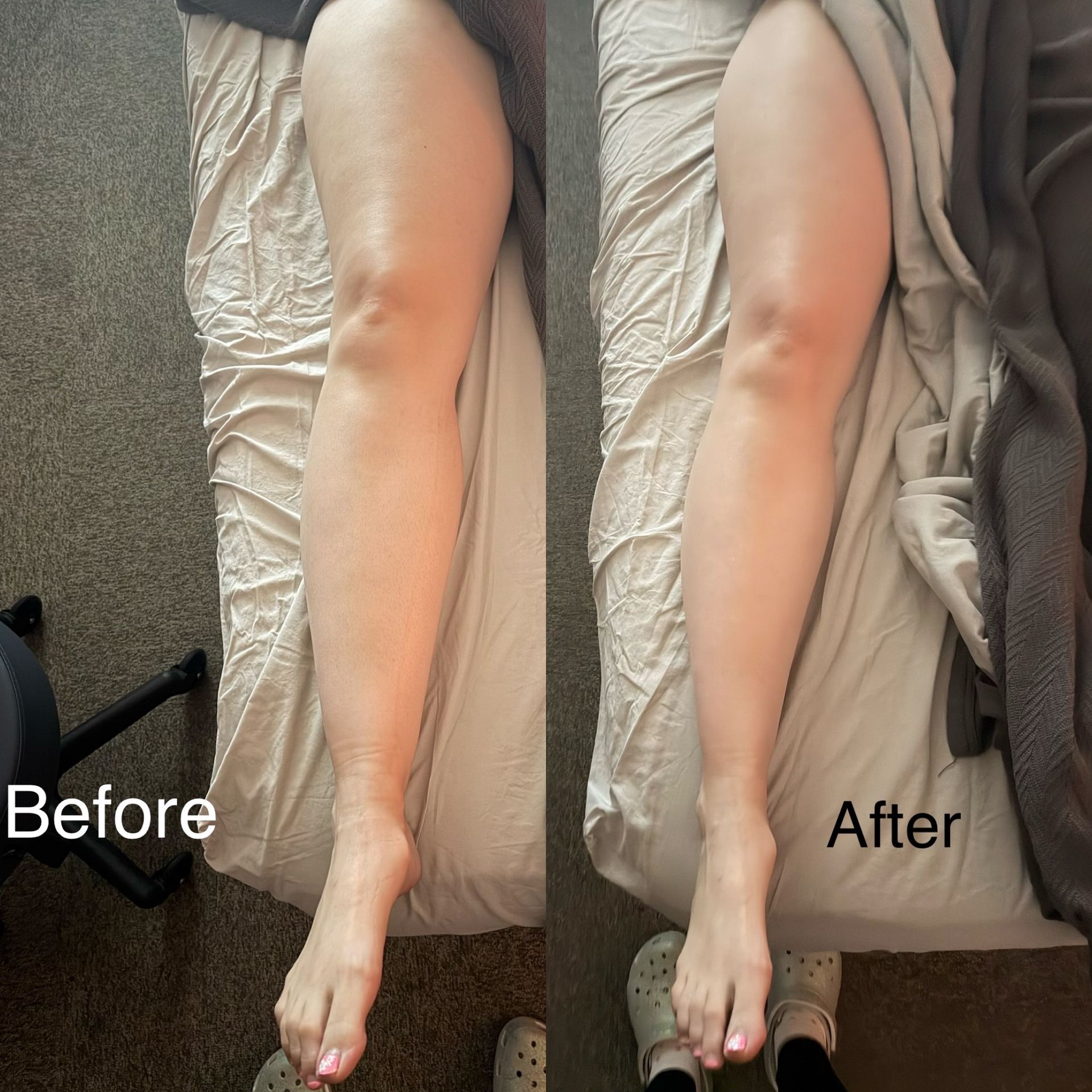 Maximizing Lipedema & Post-Op Recovery