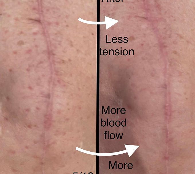 Knee Replacement Scar Treatment