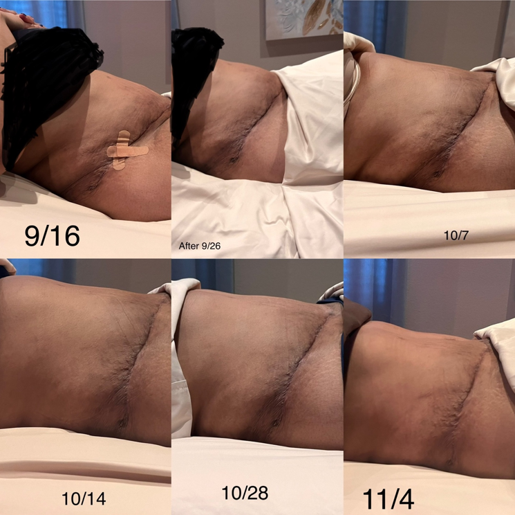 Six Week Tummy Tuck with Fibrosis Transformation 