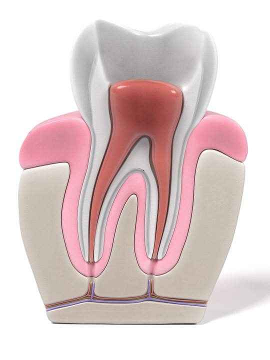 Illustrazione in sezione trasversale di un dente cariato con canale radicolare e tessuto gengivale circostante.