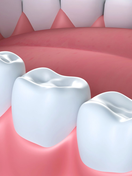 Primo piano di gengive rosa con tre molari bianchi in un'illustrazione dentale.