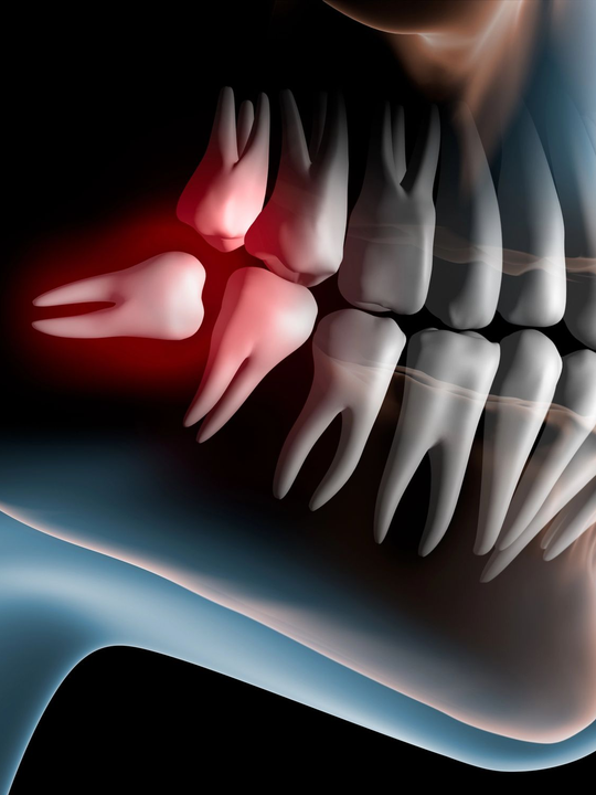 Radiografia laterale della mandibola e dei denti, con un dente evidenziato in rosso a indicare dolore o carie.