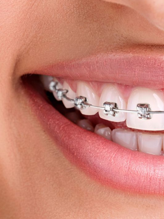 Primo piano di una bocca sorridente con un apparecchio ortodontico in argento sui denti.