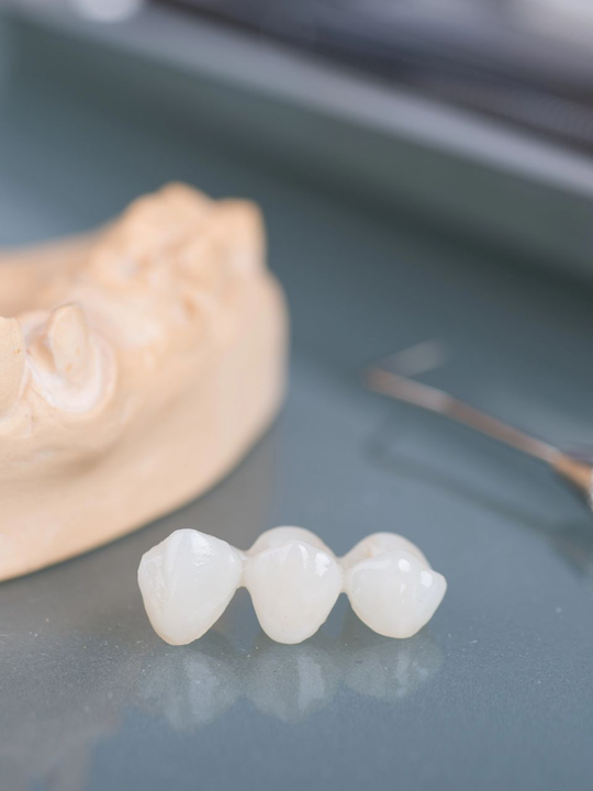 Tre corone dentali bianche accanto a un calco dentale sfocato su una superficie blu
