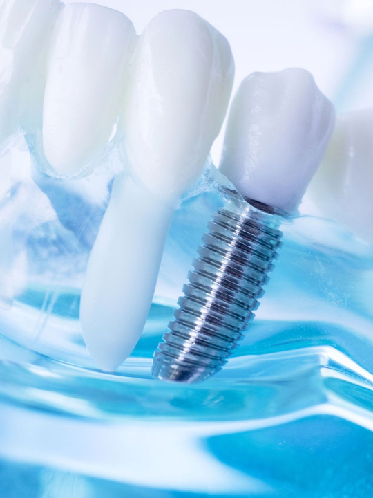 Impianto dentale accanto a denti bianchi su uno sfondo di schizzi d'acqua blu