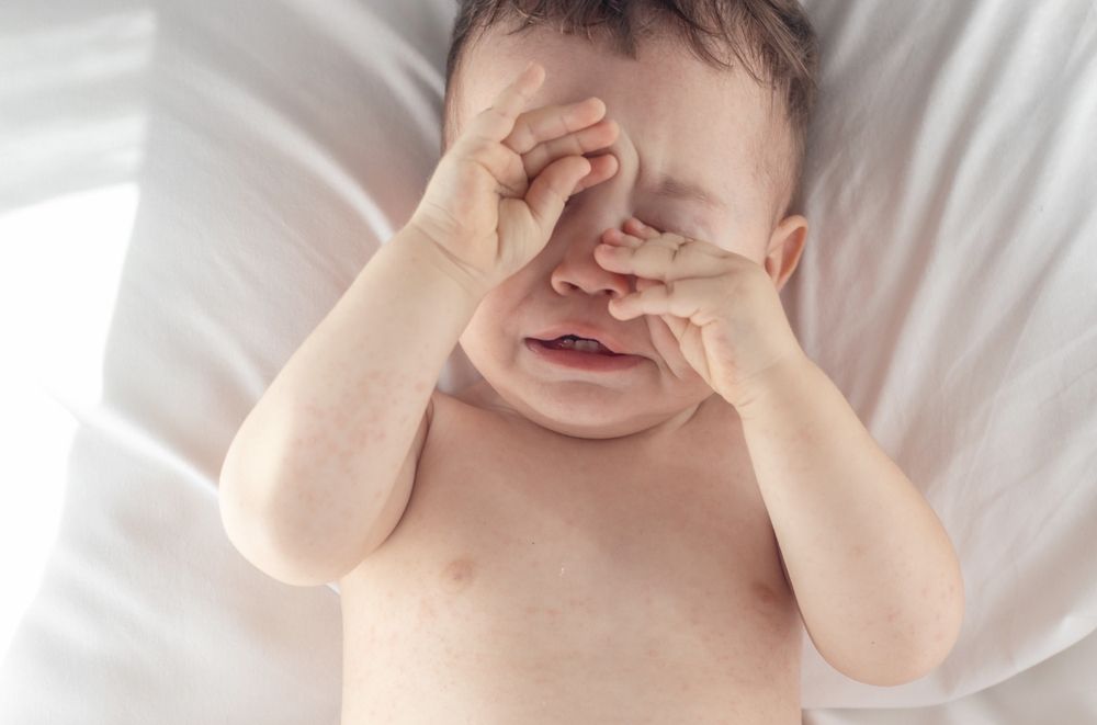 Tratamento para olhos vermelhos em Maringá Tratamento para olhos vermelhos em Maringá
