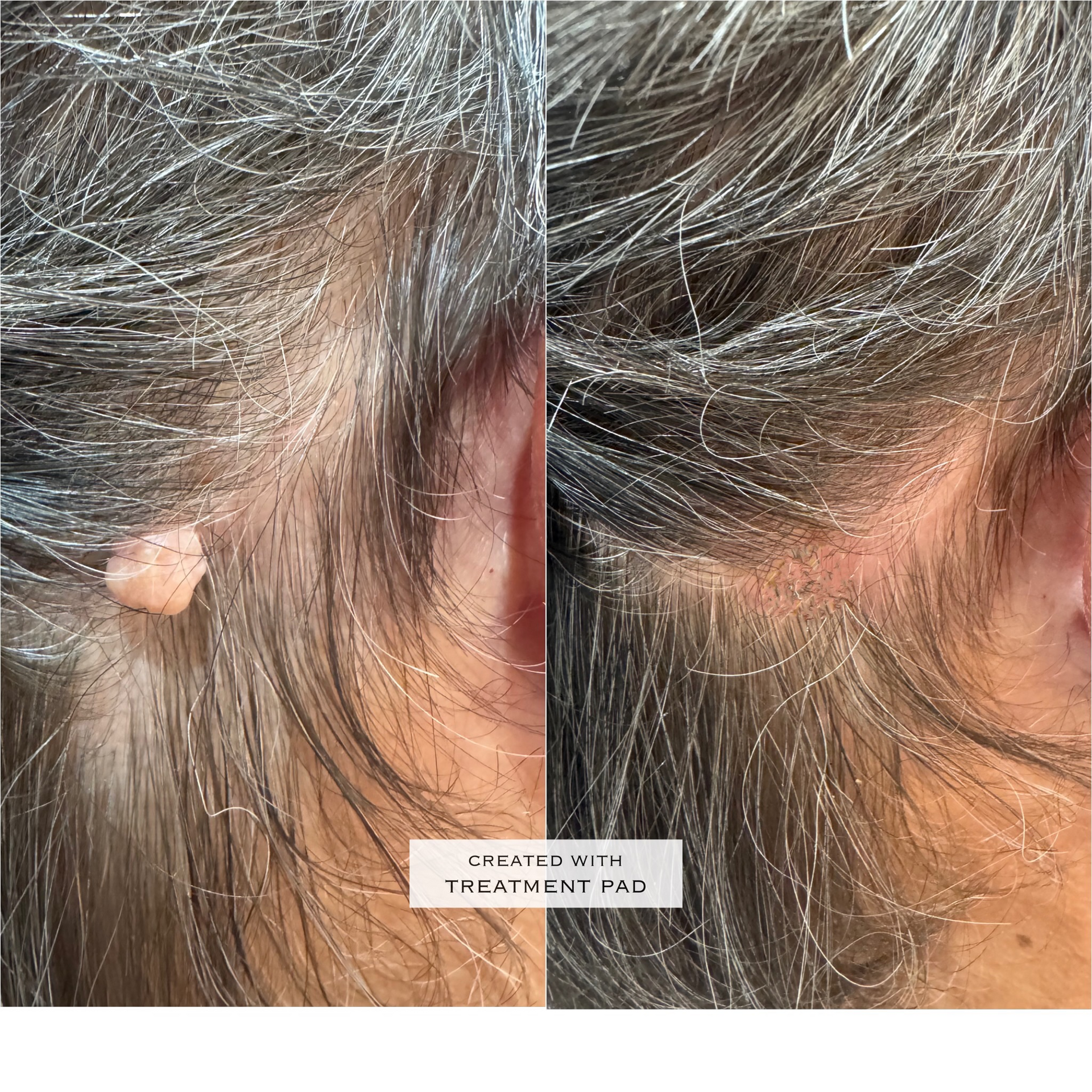 Mole re from scalp