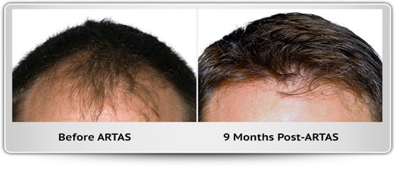 A before and after photo of a man 's hair