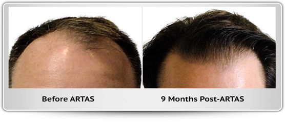 A before and after photo of a man 's hair