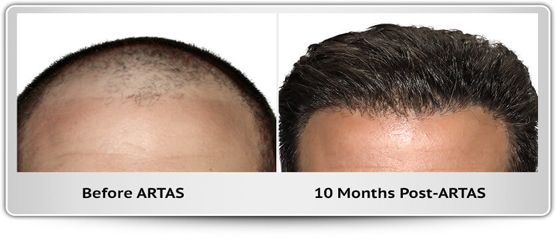 A before and after photo of a man 's hair