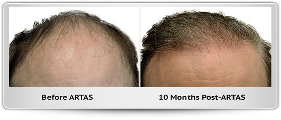 A before and after photo of a man 's hair