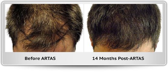 A before and after photo of a man 's hair