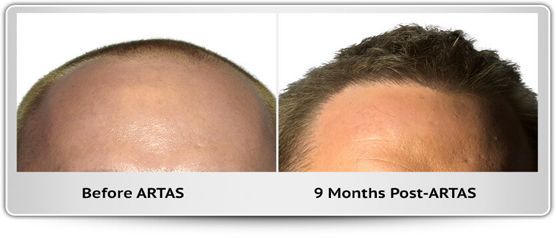 A before and after photo of a man 's head
