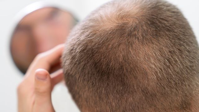 Can Mounjaro cause hair loss? Hair thinning side effects explained
