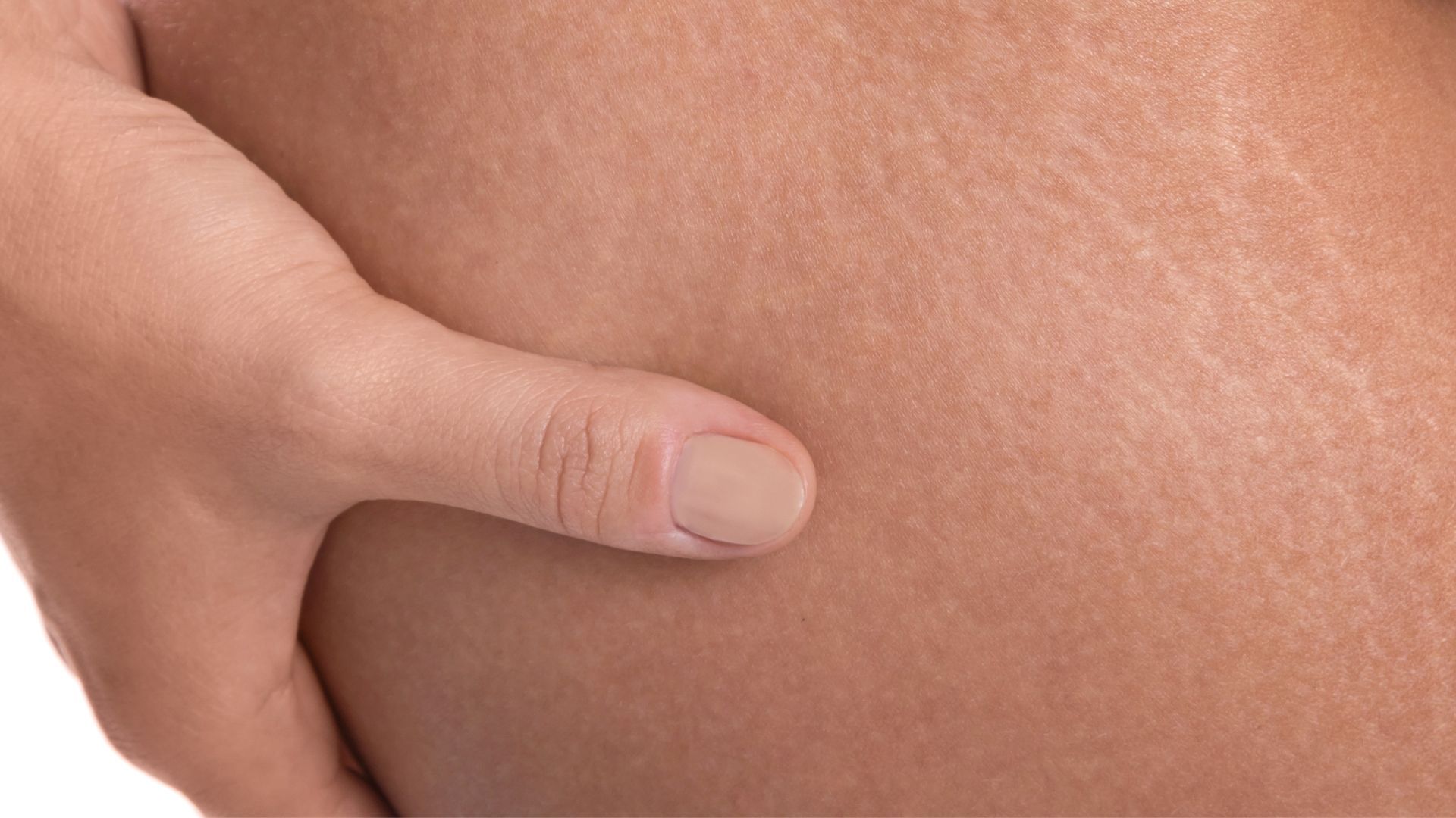 Obesity is linked to a wide range of skin problems. Learn about what causes them and what can help. Obesity is linked to a wide range of skin problems. Learn about what causes them and what can help.