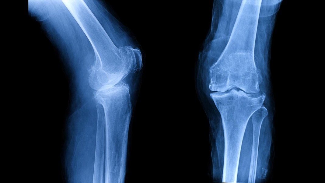 Bone and Joint Discomfort Xray
