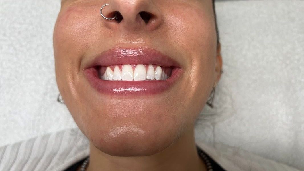 A close up of a woman 's mouth with her teeth showing.