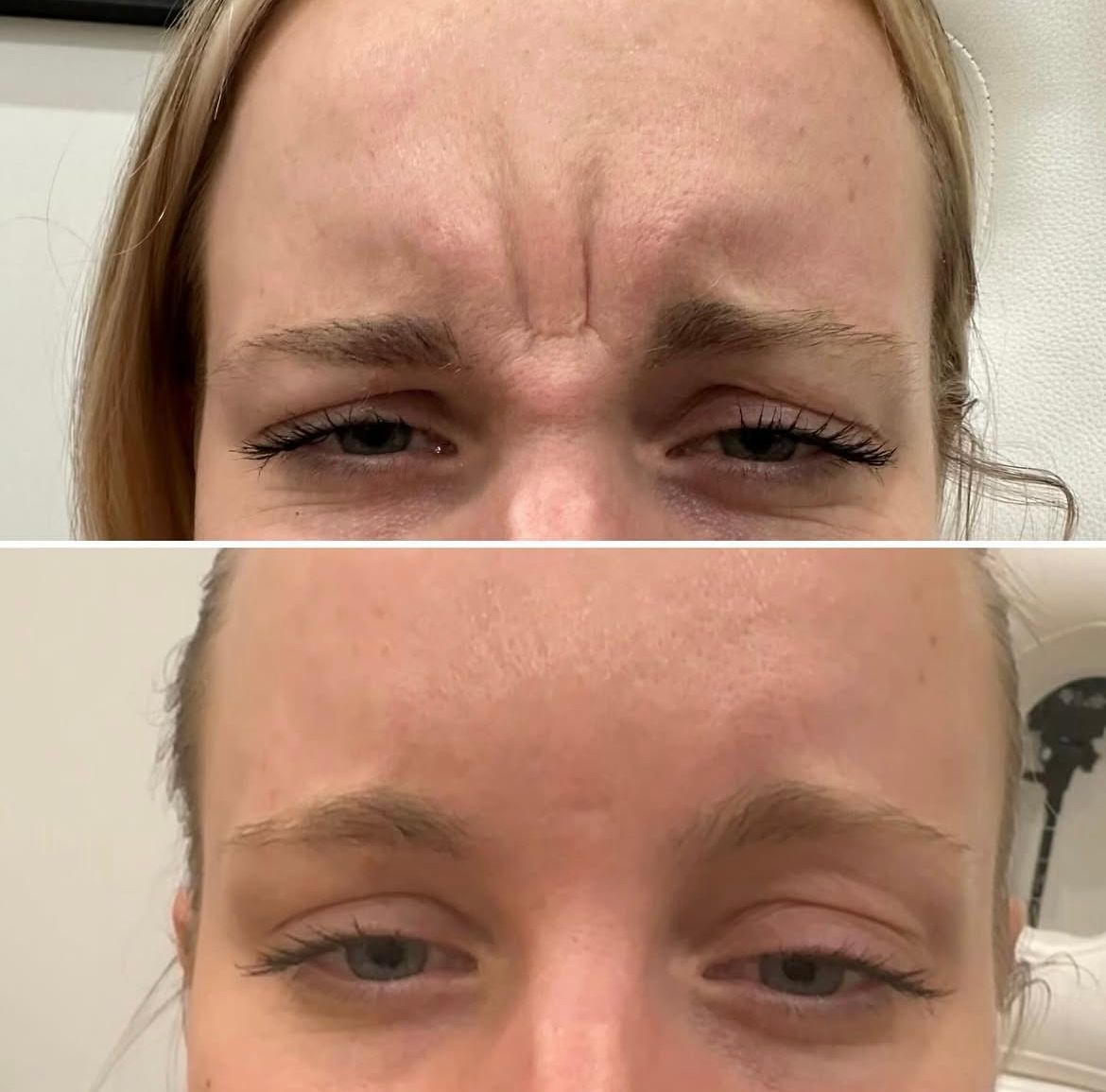 A before and after photo of a woman 's forehead with wrinkles.
