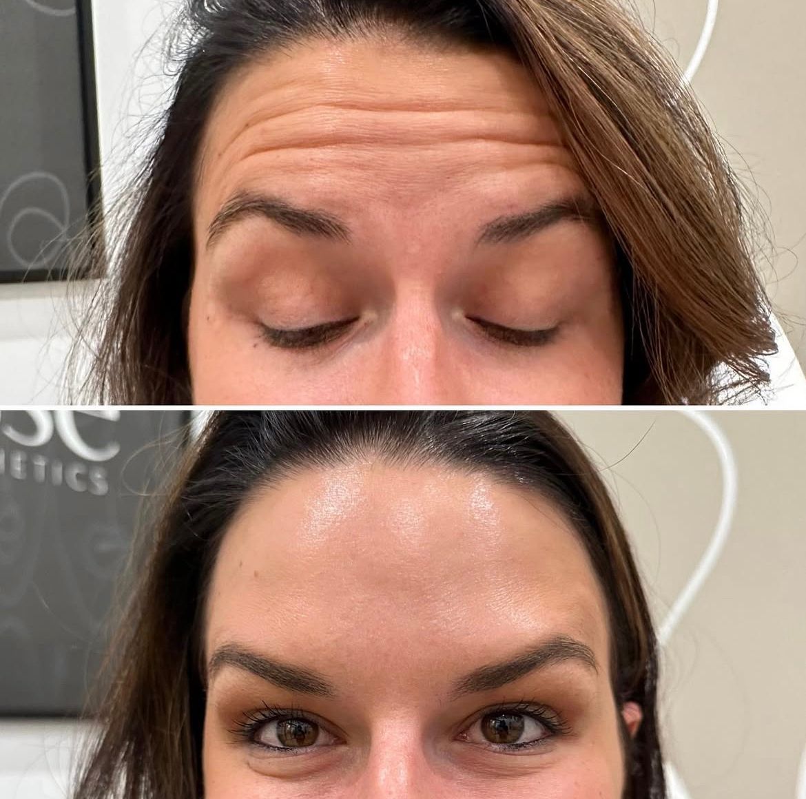 A before and after photo of a woman 's forehead.