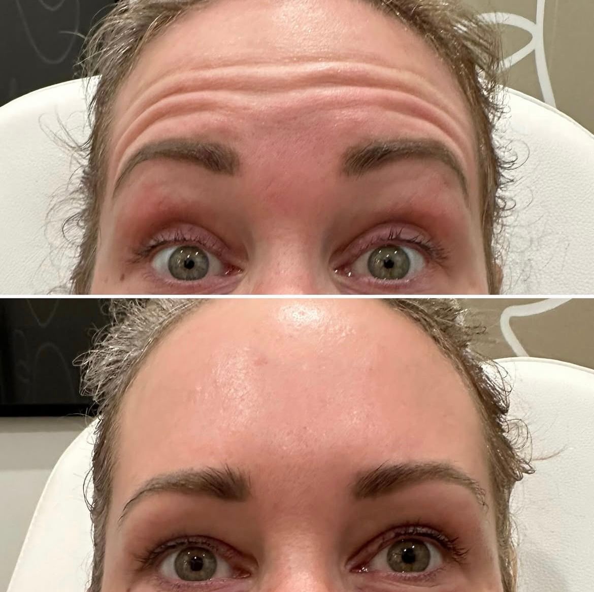A before and after photo of a woman 's forehead