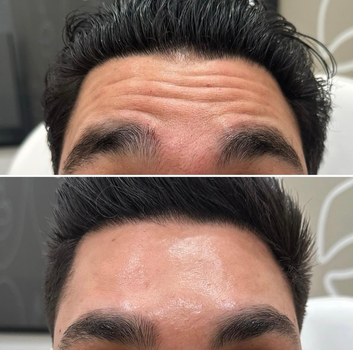 A before and after picture of a man 's forehead.