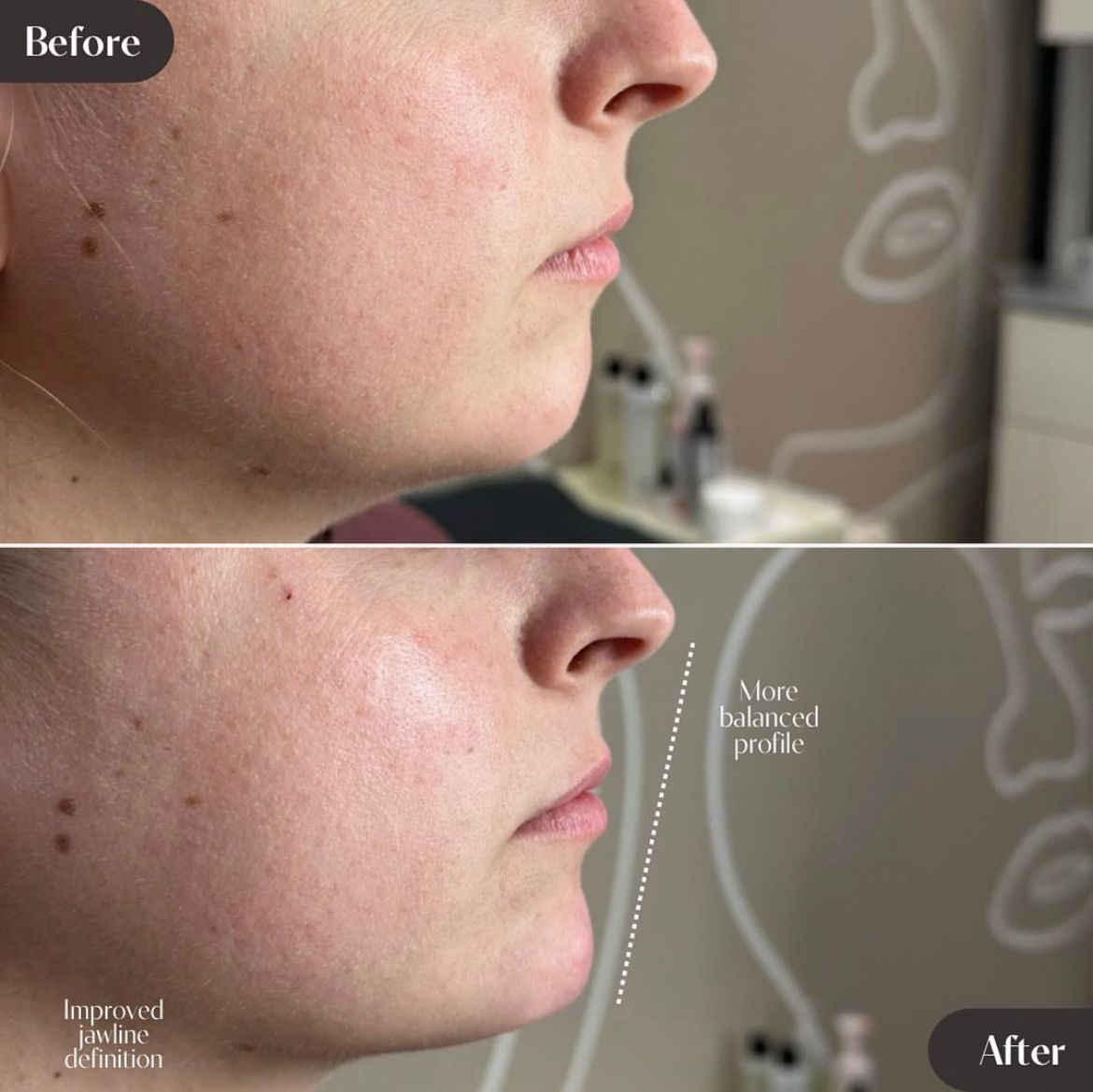 Injectables | Esse Aesthetics | Overland Park, KS