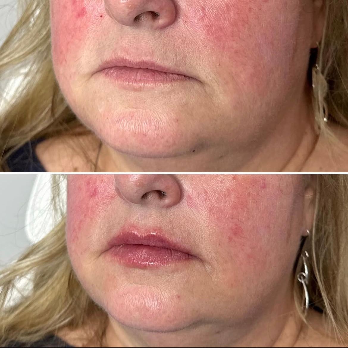 Injectables | Esse Aesthetics | Overland Park, KS