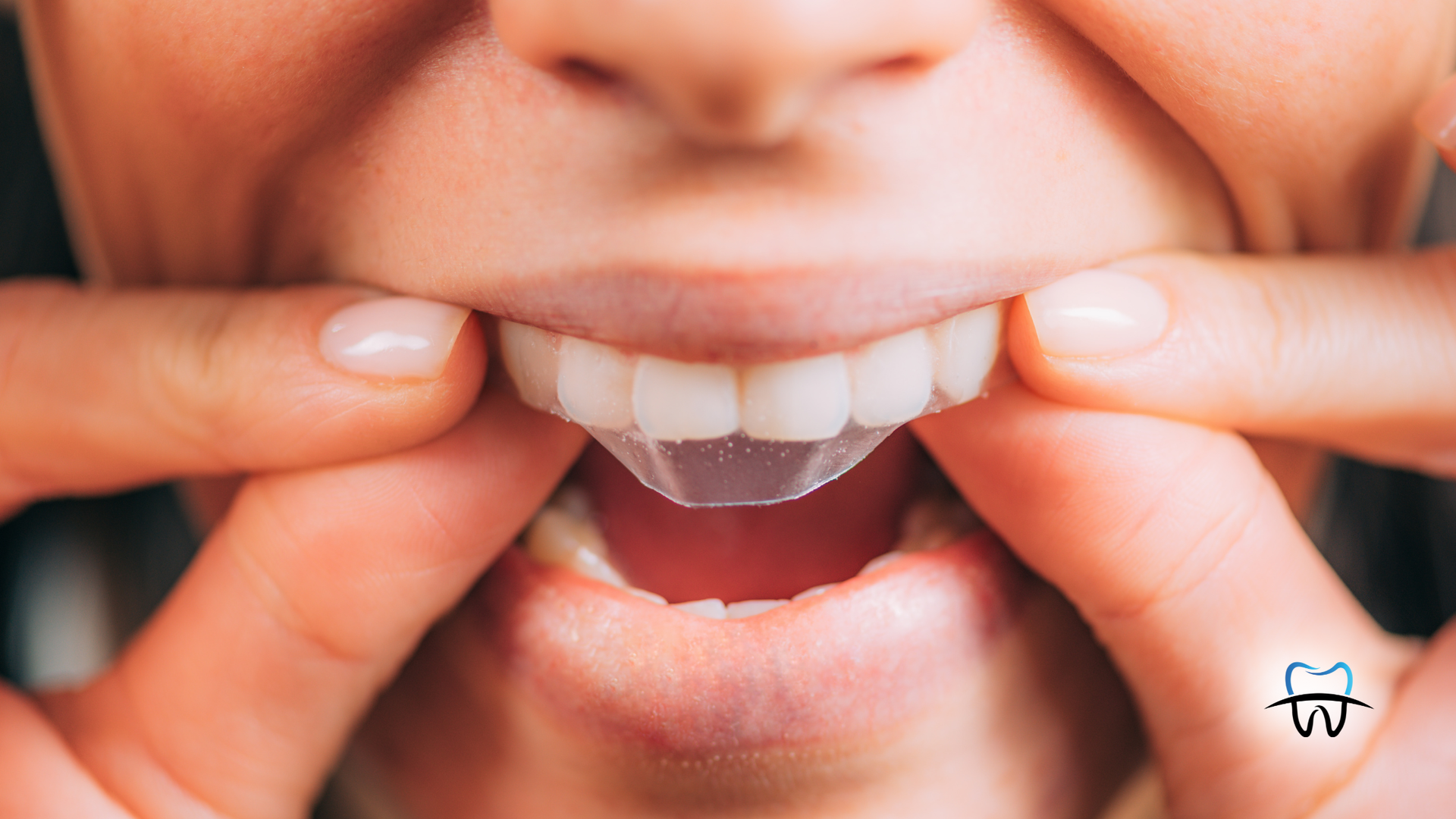 Person holding a clear dental retainer over their teeth, pulling back their lips.